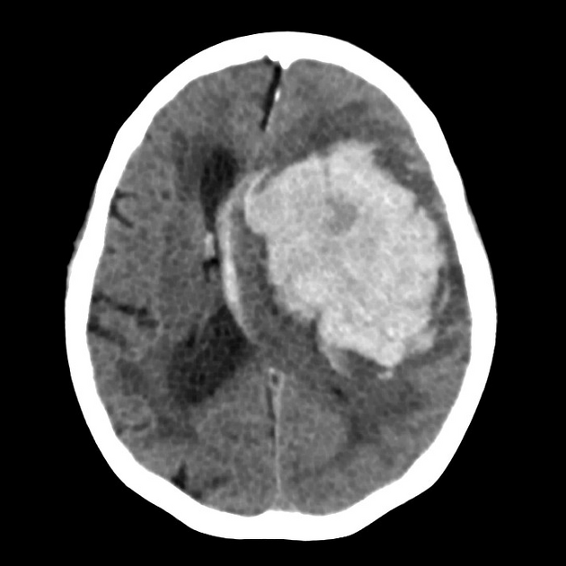 hyderabaddoctor's tweet photo. High BP can damage your brain without warning

🔸In the last couple of weeks, unfortunately, we had a series of young people presenting to the emergency department with BRAIN HEMORRHAGE (Bleeding in brain tissue). 

🔸They were previously healthy; they did not smoke or drink and there was no family history of stroke.

🔴The common risk factor in all of them was Hypertension (high blood pressure).

🔸High blood pressure can silently damage your brain, heart and kidneys, even when you feel perfectly healthy.
🔸The dangerous part is that you may have no symptoms.

FIVE things everyone should know:
1. Don’t wait for a headache to check BP.
2. Measure it correctly and repeat abnormal readings.
3. Reduce excess salt and ultra-processed foods.
4. Exercise regularly and sleep adequately.
5. If BP remains high, don’t ignore it; or stop prescribed medicines on your own. Consult your doctor. 

❓When did you last check your BP?
Repost this. Someone in your family may need the reminder.

Dr Sudhir Kumar             @hyderabaddoctor