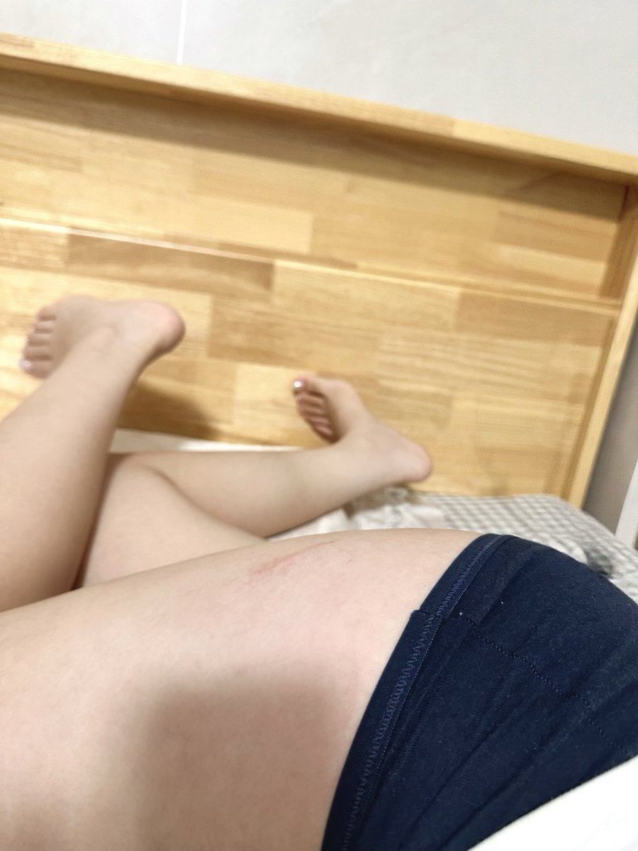 ysu1724758's tweet photo. 昨天下车的时候被电动车刮到了🥹好痛，我的皮都掉了，今天看了一下都有淤青呜呜呜，感觉又要留疤了🥹 https://t.co/aPZGX8iv8e
