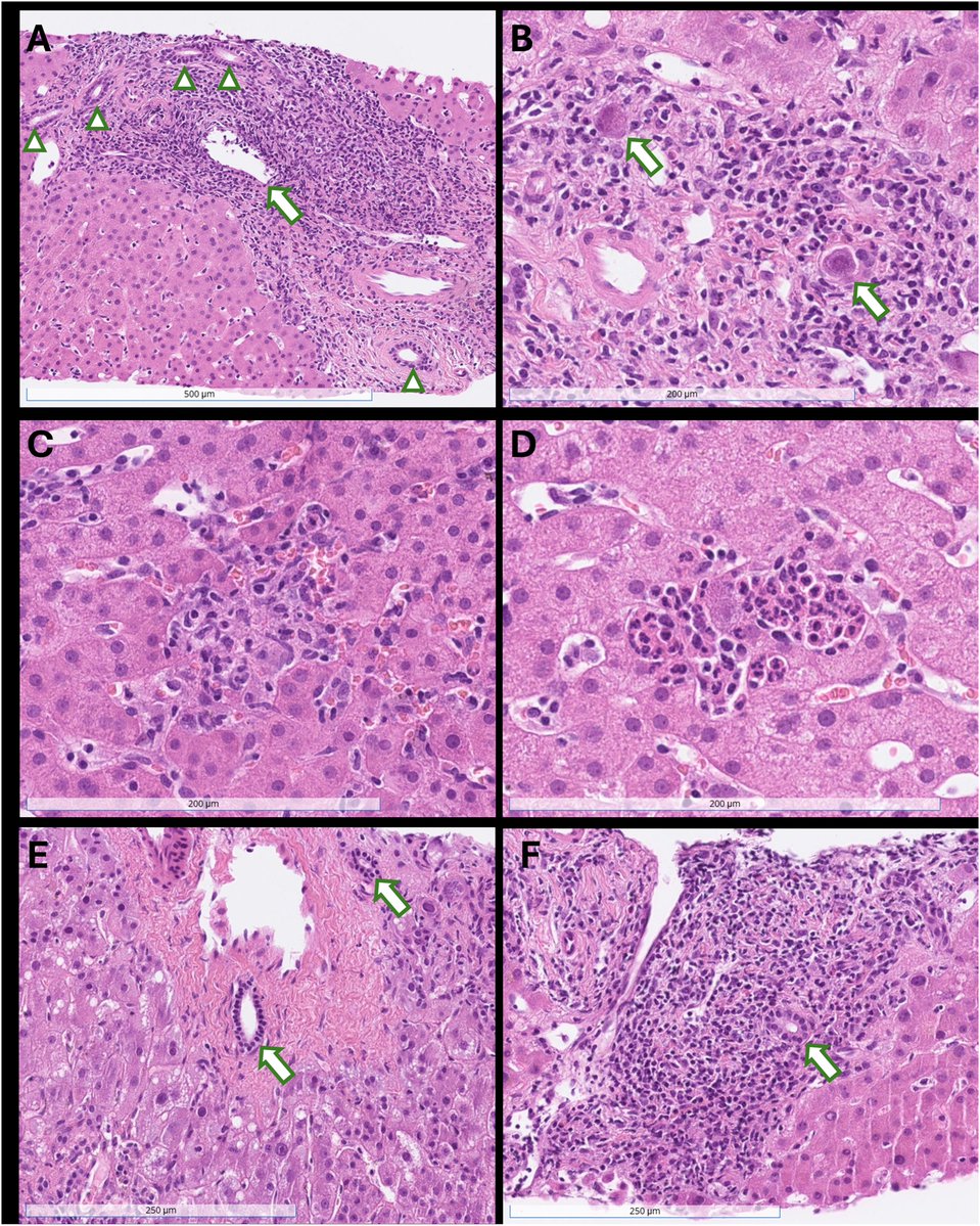 IJSPjournal's tweet photo. Histologic features favoring CMV hepatitis in liver allograft biopsies with overlapping rejection-type injury
➡️Microgranulomas
➡️Neutrophilic microabscesses
Difficult topic, covered by IJSP. Read more here 👉🏼 https://t.co/Nz0Ofdy4W9
#PathTwitter #GIPath #MedicalLiverPath https://t.co/gzqLQkzQYN