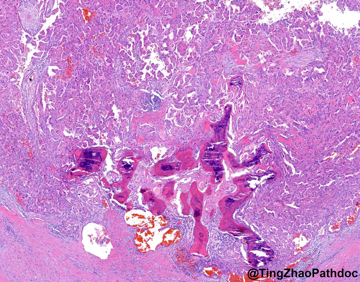TingZhaoPathdoc's tweet photo. 50s M with a renal mass. Diagnosis?
@MGBpathology
#PathX #PathTwitter https://t.co/9uxv3Q9xiD