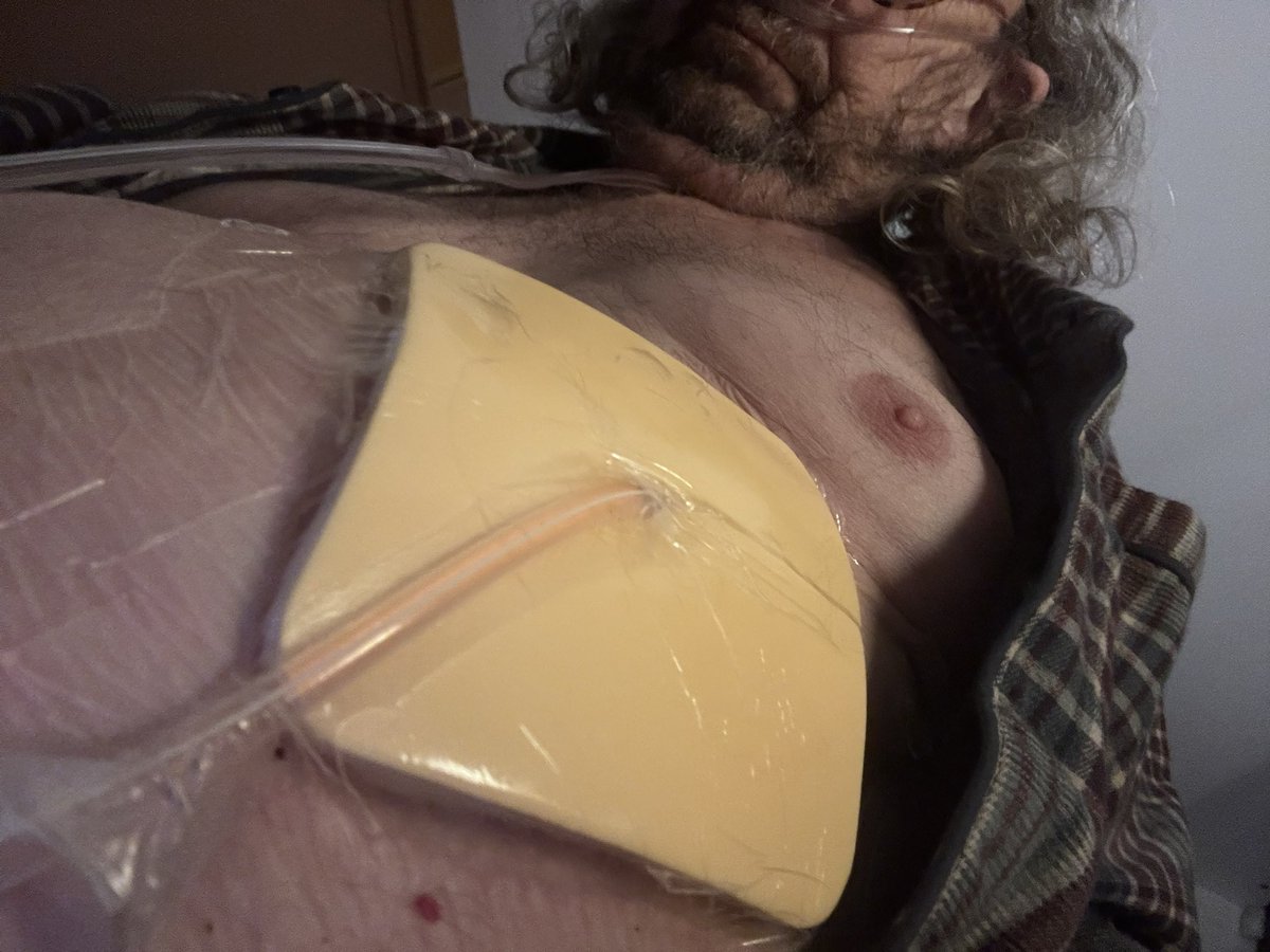 WhatNowDoc's tweet photo. Shall we talk about Chest Drainage, just for a change?
So I have this device inserted around my lung and it drains all sorts of yucky fluids from the pleural cavity from around my lung. It’s designed to end in a short pipe which would normally be laid under the dressing through which you see the pipe passing in the first picture. I’ve spared you the one of the tube coming out of my abdomen. 
Then there’s a special suction bag, 500 quid a piece someone said, which is supposed to be attached each time they change the dressing and clean it up. I have two of these at home. Unused so far. District Nurses are the ones tasked with that, 2-3 times a week. So, about a week ago, they changed the dressing, late. Now we’re late again. That first time I raised the question of whether or not, given we’re draining around 300ml/day, it wouldn’t be better to continue with the open drain. Do the maths, even once a week that’d be me carrying 2.1 ltrs/kgs of fluid around before they drained it. That’s serious pain. I want a smaller (much cheaper) version of what I’ve got. So since then I’ve tried everything. No one knows what to do, what’s available, nor really how it all works.  GP says hospital, hospital says District Nurse, Hospice agrees, District Nurses say “dunno”.
We know because today, in desperation, we spoke to the sales rep for the company, she’s the one who trains the District Nurses. When we told her the bag is precisely two weeks old, she described that as a medical emergency. 

Apparently it’s all down to the lack of a one way valve which opens up the possibility of reverse flow infection and that’s one of the three main ways we leukaemia kids die: sepsis from infections we have no immune response for. 

So I’ve made sure every part we can get to has been doused in alcohol, the M&S carrier bag exchanged for a new one and all surfaces sprayed with Dettol. Till tomorrow when, possibly, the District Nurse comes calling. 

If I have to learn all this then so must you all. Night night. 😘