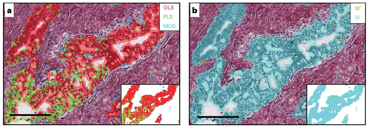 StainsFile's tweet photo. Single-cell master regulator analysis of multiple #PDAC cohorts identified malignant cells in three co-existing, molecularly distinct developmental lineage states, each with distinct histopathological morphologies and spatial architecture.

Abstract: https://t.co/l5niR0IdYx https://t.co/nqFNWqm5do