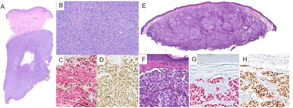 Human_Pathology's tweet photo. New in #HumPathol: Comprehensive Genomic Characterization of Primary Dermal Melanoma: Delineating it from Metastatic Melanoma with Unknown Primary. https://t.co/9sdBv13cJo #pathology #PathTwitter #PathX #dermpath https://t.co/Phjf9gQHhH