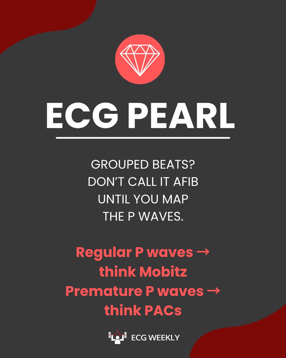 ECGWeekly's tweet photo. Grouped beats ≠ automatically AFib. 🔎

Map the P waves:
Regular → Mobitz
Premature → PACs

The rhythm may be hiding in the atria. https://t.co/U5CB9PwAth