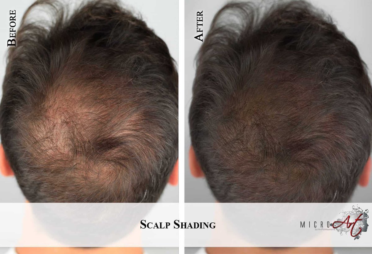 Micro_Art's tweet photo. MicroArt Scalp Shading is perfect for men or women: All styles and types of hair!
Learn more👉 https://t.co/xmBK2HZYYL
#microart #scalpshading #hairloss #smp https://t.co/RVvDS4izJo