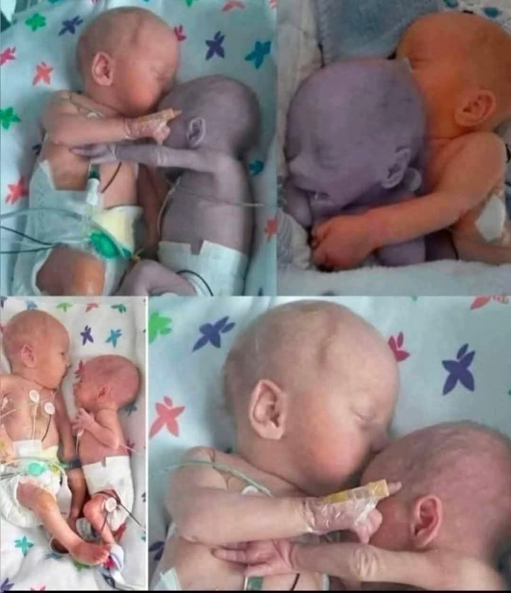 Evelyn001d's tweet photo. In 1995, inside a small Massachusetts hospital, a pair of newborn premature twins fought the hardest battle of their tiny lives. Born far too early, Kyrie and Brielle weighed barely enough to fill a nurse’s hands. Both fragile… but one fading faster than anyone expected.
Kyrie, the stronger twin, slowly gained strength.
But Brielle — so tiny, so exhausted — was slipping away. Her breathing stuttered. Her oxygen levels dipped again and again. Her skin turned a worrying shade of blue. Doctors prepared the family for the unthinkable: she may not make it through the night.

And then came a moment of quiet courage.

A nurse named Gayle Kasparian, guided not by procedure but by pure human instinct, made a decision that defied the rules of the time. Back then, premature babies were always kept in separate incubators.

But she believed something else.
She believed that love — even the smallest kind — had power.

Gently, she lifted Kyrie and placed her beside her struggling sister in the same incubator. Two tiny hearts, side by side. Two tiny bodies, skin to skin, just like they had been in the womb.

What happened next brought the entire neonatal unit to tears.

Within minutes, Brielle’s monitors changed.
Her oxygen levels rose… higher… higher.
Her heartbeat steadied — strong and sure.
Her frantic breathing calmed.
Color returned to her cheeks.

And then, in a moment that seemed almost like a whisper from heaven, Kyrie lifted her tiny arm and wrapped it around Brielle… as if she was holding her sister here on earth.

The nurses stood frozen.
Doctors rushed in.
No one could explain it — but no one could deny it.

That single embrace didn’t just save Brielle’s life…
It changed medical care forever.

Because of these twins — because of one nurse who simply followed her heart — “co-bedding” premature babies is now used in hospitals around the world.

All because two sisters reminded us of something simple and profound:

Sometimes the greatest medicine
is love in its purest form.