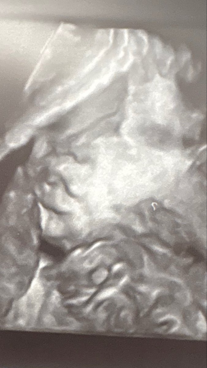 therealyaeniomi's tweet photo. the ultrasound vs the newborn🥹❤️.
#explore #babies #newborn https://t.co/EpptCFdk7k