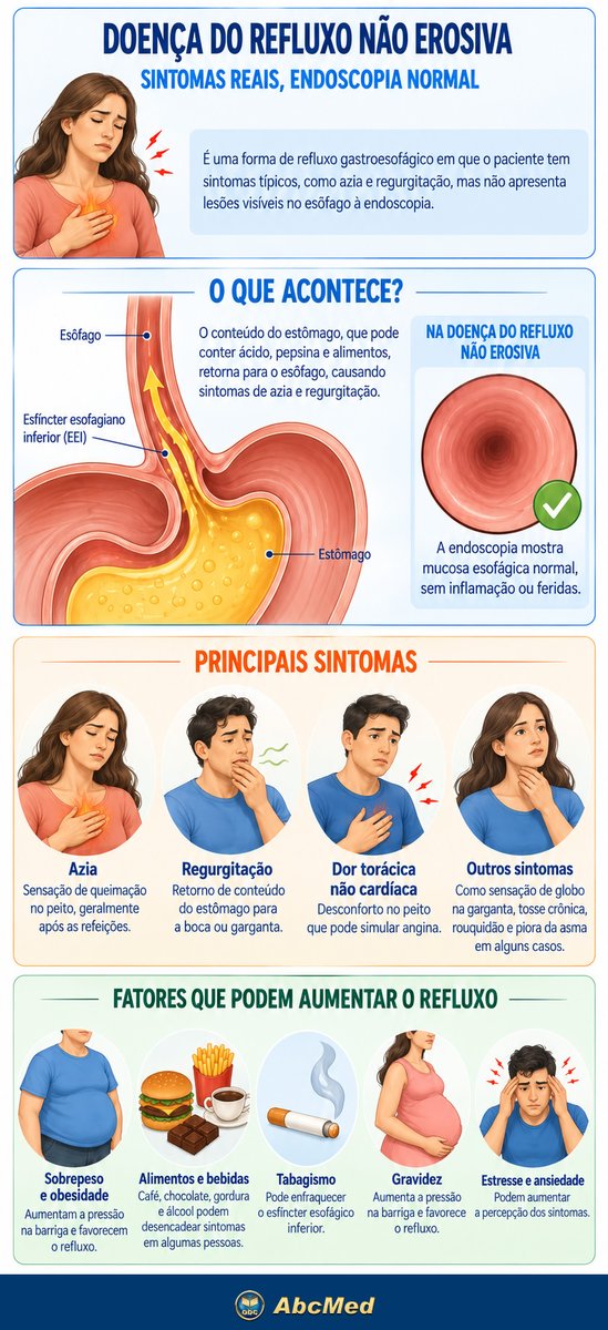 abcmedbr's tweet photo. Doença do refluxo não erosiva: como é possível ter refluxo mesmo com endoscopia normal?
https://t.co/WCSl9hXIAv
A doença do refluxo não erosiva causa principalmente azia e regurgitação, apesar da ausência de esofagite erosiva à endoscopia.
#Refluxo #Gastro #Azia #DRNE #DRGE https://t.co/wbNApUYlv8