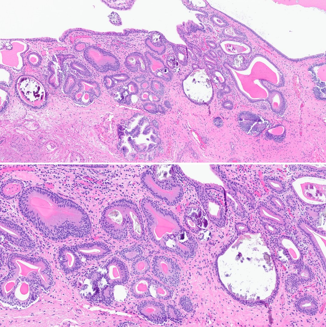 slusagar's tweet photo. #GUpath TURBT for cystoscopic tumor
🔬#beautyinb9 cystitis cystic glandularis with IM
in the absence of associated dysplasia, most studies show no strong risk for malignancy https://t.co/hKMsho2WyY
