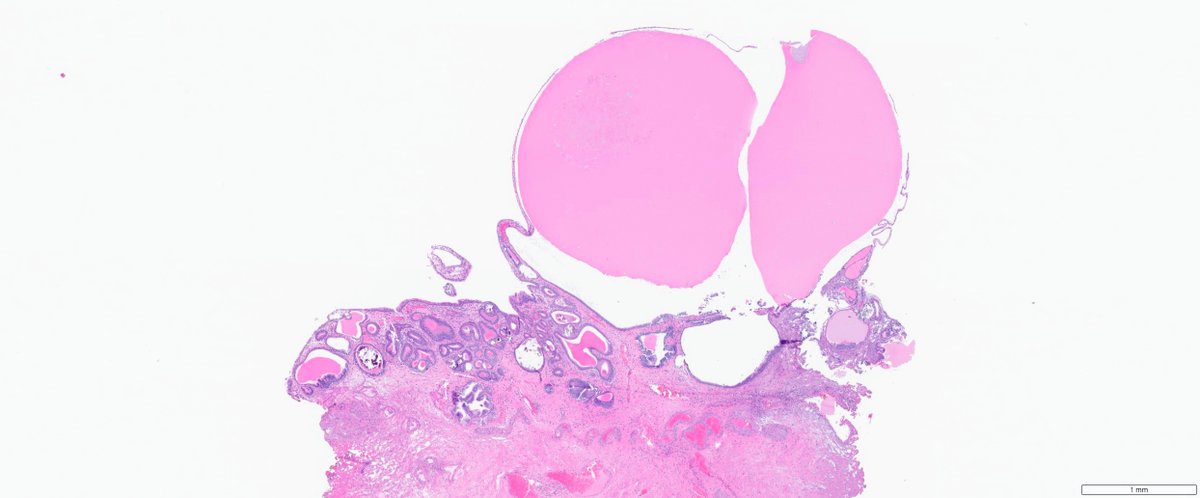 slusagar's tweet photo. #GUpath TURBT for cystoscopic tumor
🔬#beautyinb9 cystitis cystic glandularis with IM
in the absence of associated dysplasia, most studies show no strong risk for malignancy https://t.co/hKMsho2WyY