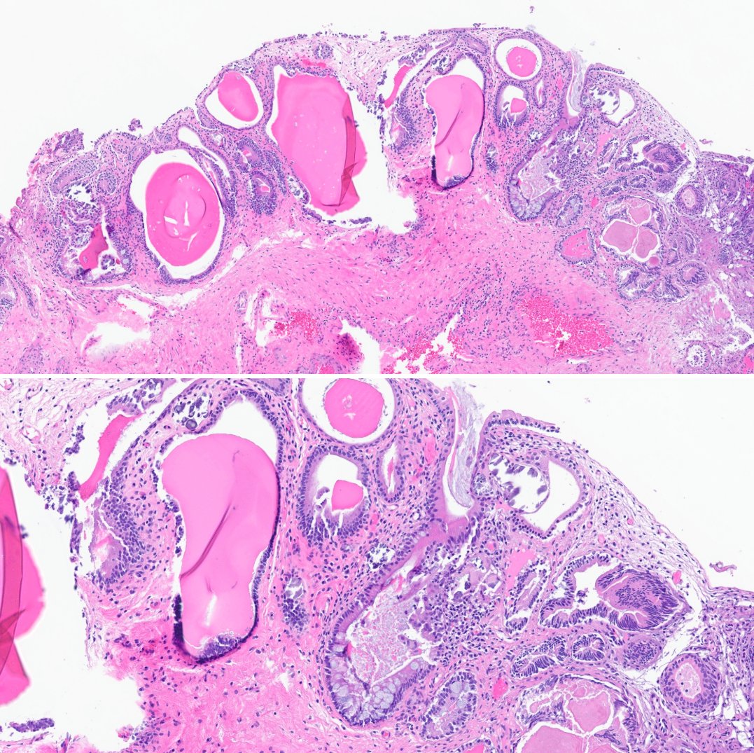 slusagar's tweet photo. #GUpath TURBT for cystoscopic tumor
🔬#beautyinb9 cystitis cystic glandularis with IM
in the absence of associated dysplasia, most studies show no strong risk for malignancy https://t.co/hKMsho2WyY