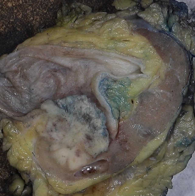 slusagar's tweet photo. #GUpath #grosspath radical nephro-ureterectomy
high grade urothelial carcinoma, invading renal parenchyma (pT3) https://t.co/pi2h6z7JEW