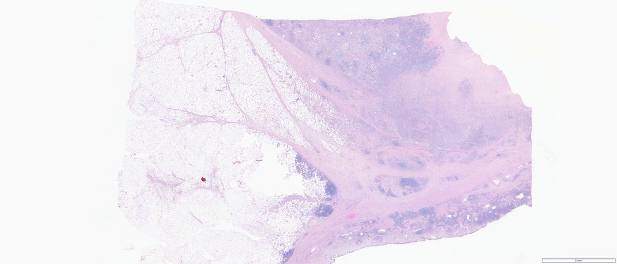slusagar's tweet photo. #GUpath #grosspath radical nephro-ureterectomy
high grade urothelial carcinoma, invading renal parenchyma (pT3) https://t.co/pi2h6z7JEW
