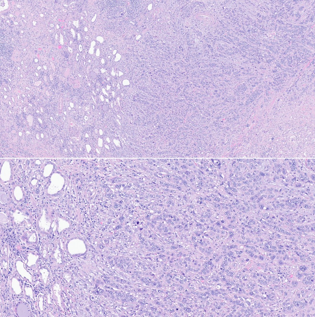 slusagar's tweet photo. #GUpath #grosspath radical nephro-ureterectomy
high grade urothelial carcinoma, invading renal parenchyma (pT3) https://t.co/pi2h6z7JEW