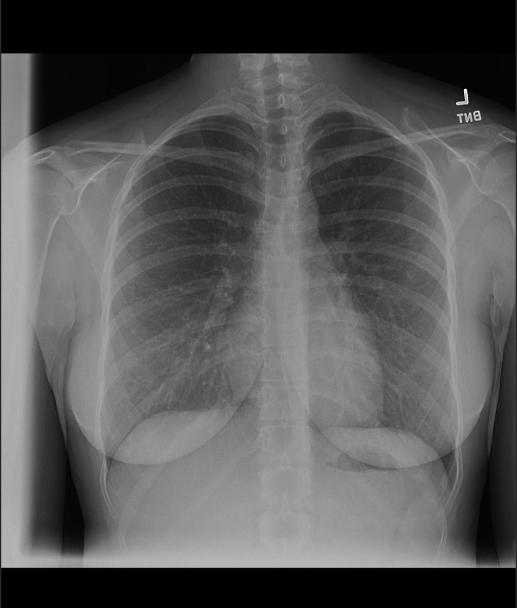 ravenn0ir's tweet photo. My heart only beats for you 🖤
Yes, this is a real X-ray of my chest... I've got a big heart, I know :3
#nsfwtwt #nsdw https://t.co/GnWug4dl0U
