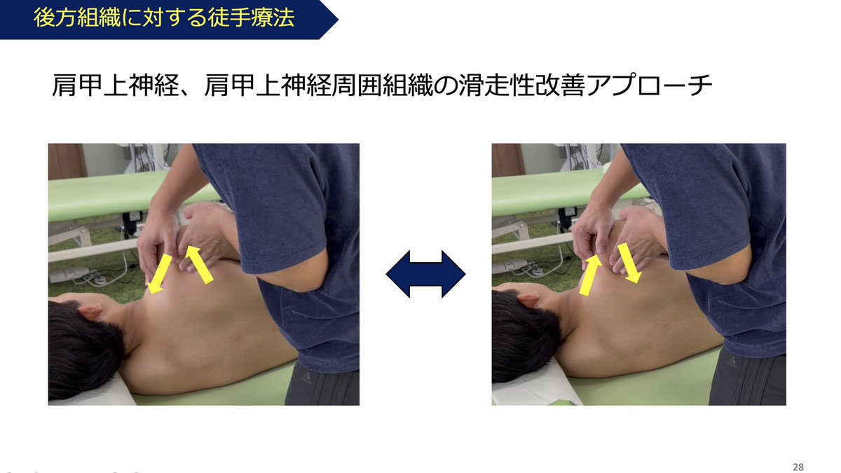 Hffy23's tweet photo. 後方タイトネスが、肩内旋可動域や骨頭の位置、投球動作にどのような影響を及ぼすか。

「肩関節内旋制限をどう評価するのか？」
「評価結果をどのように治療につなげるのか？」

こうした疑問を整理し、投球障害の臨床に活かせる内容をお届けします！
@Spo_Lab https://t.co/v9VgAPJkrN