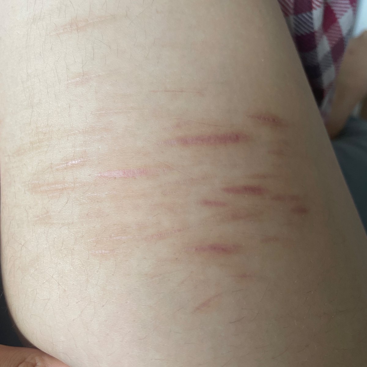 dopamiene13's tweet photo. am i scarspo yo #ouchietwt #shrtwt #shedrtwt don’t mind my fatass legs

ALL FAKE AI GENERATED PHOTO https://t.co/U3BKR0W6RF