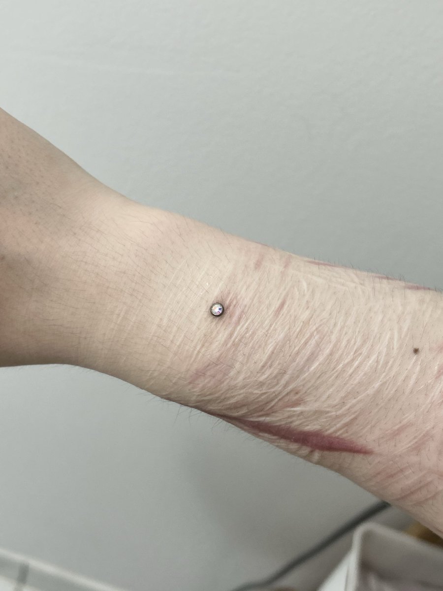 Elegy_of_Lilacs's tweet photo. my dermal is a little angry at me i hope it doesn’t reject…still sparkly though! https://t.co/5TR6OEU2Sq