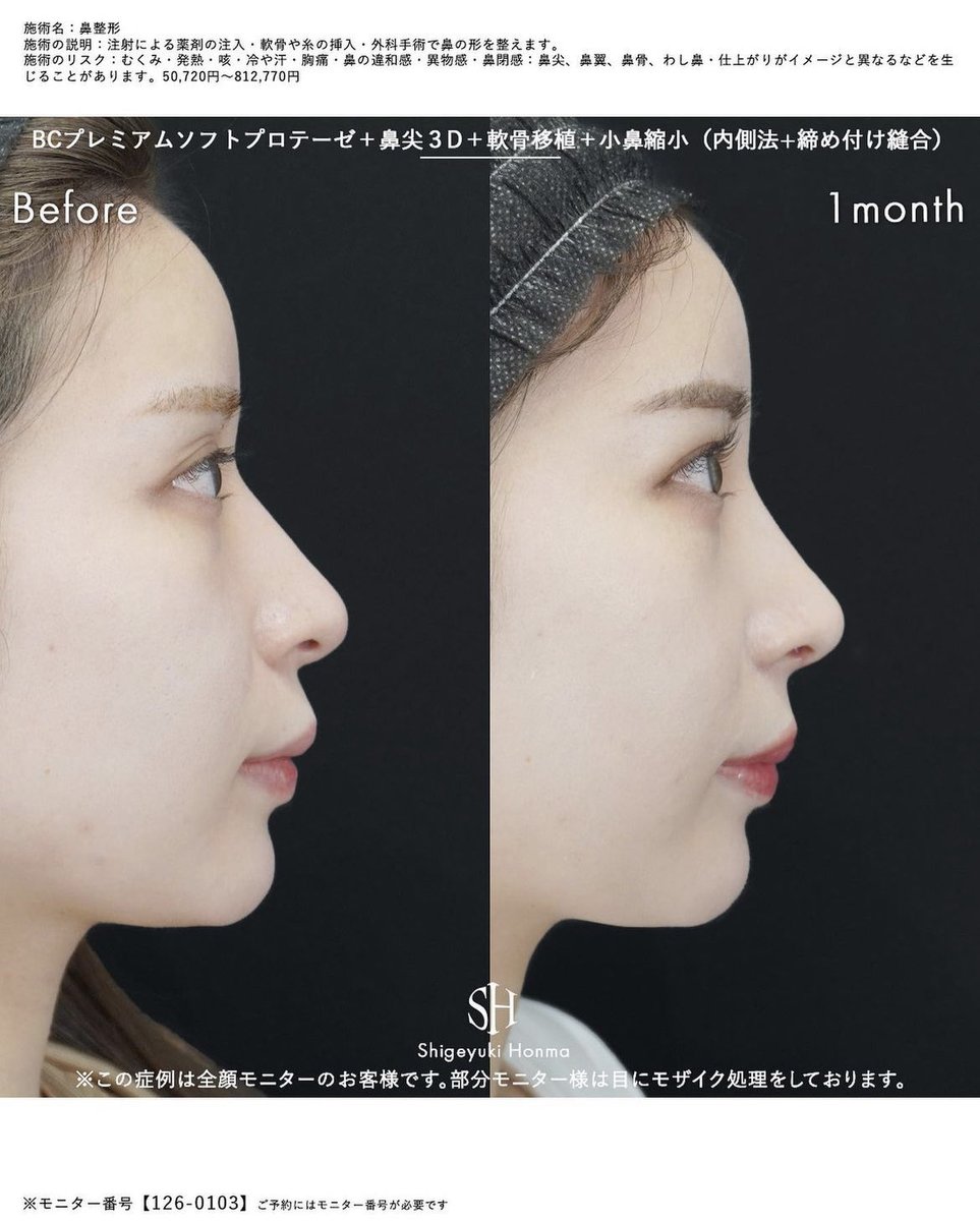 s_shonma5's tweet photo. この二つの術式だけで綺麗になる人は確かにいますが、みんながみんなそうなる訳じゃないので注意が必要です。

鼻尖形成と軟骨移植だけ(小鼻は別の話なので一旦置いときます)で綺麗になるにはいくつかの条件があります。

①鼻先の位置が適正である
②ACRが整っている
③鼻翼軟骨がしっかりしている

等です。

①は、鼻先の位置が上向き(豚鼻)でも下向き(魔女鼻)でもなくまっすぐ適正な位置にあることです。

②は、正面から見たときに鼻柱が適度にあり、下に凸の理想のACRの状態です。

③鼻翼軟骨の強度がない人に鼻尖形成と軟骨移植だけ行っても、直後から数ヶ月はいい感じになりますが、ほぼ確実に後戻りします。土台の弱い基盤の上に軟骨を積み重ねたところで沈み込んで終わりです。

つまり①〜③の条件を満たす人は鼻尖形成と軟骨移植だけでもかなり綺麗になりますが、正直こういう方は元々鼻が綺麗なので相談にもほとんど来ません。

逆に鼻にコンプレックスを抱えている方は①〜③の条件を満たしていない方が大多数です。

「この人がこの術式で綺麗になってるから私も」
ではありません。
鼻の形は人により千差万別です。であれば当然必要な術式も人により異なります。

皆さん、症例写真を見るときに術後ばかり見がちですが、ぜひ【術前】もしっかり見て下さい！自分の鼻に近い術前の写真でないと何の参考にもなりませんよ！

＊添付の症例写真は全て鼻中隔延長や鼻柱下降なし(鼻先は鼻尖形成＋軟骨移植のみ)の症例です。皆①〜③の条件を満たしており術前から綺麗な鼻尖であることがわかると思います。