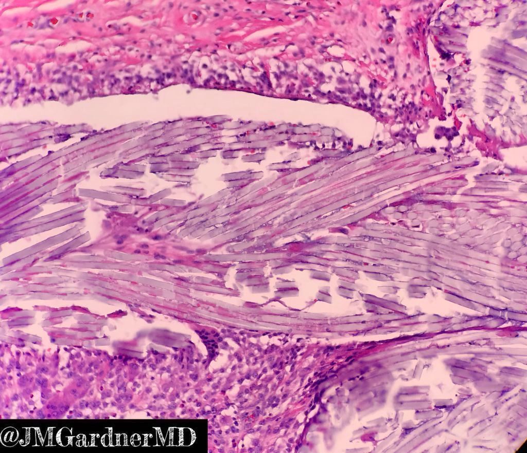 JMGardnerMD's tweet photo. What's this beautiful rainbow?
Answer ✅ https://t.co/BGLOsVGjYA
When I see this, I pop in the polarizer filters (pics 1&2) on my microscope to get appropriate oohs & aahs from new #pathology trainees & #medstudents!
#meded #pathology #pathTwitter #dermpath #dermtwitter https://t.co/sG4T67JFKo