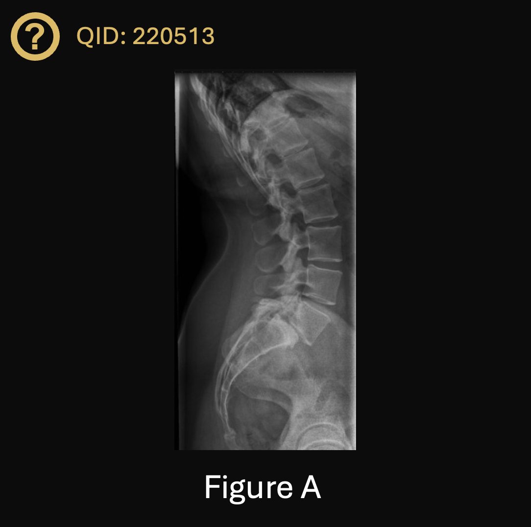 orthobullets's tweet photo. Can you answer our free question of the day?

A 46-year-old male presents to the clinic with a chief complaint of lower back pain. He has longstanding lower back pain; however, 6 months prior, he had an increase in radicular pain down bilateral lower extremities and was diagnosed with adult isthmic spondylolisthesis. He had trialed activity modification, anti-inflammatories, and a trial of transforaminal epidural steroid injections 4 months prior. He received moderate relief lasting four weeks but is now interested in surgical intervention. His lateral lumbar films are shown in Figure 1. The surgeon recommends interbody fusion with posterior fixation. 

When counseling the patient regarding operative options, which is true when comparing anterior lumbar interbody fusion (ALIF) to transforaminal lumbar interbody fusion (TLIF)?

1. ALIF results in greater restoration of disc height

2. ALIF is associated with higher 1-year post-operative pain scores

3. ALIF and TLIF result in equivalent segmental lordosis

4. ALIF is associated with a higher risk of postoperative complications

5. ALIF is associated with a lower fusion rate

QID: 220513
Comment your answer below, then check to see if you got it correct by clicking the link below to see the answer & explanation.

https://t.co/MrCkMCkG3i

#orthopedics #orthopedicsurgeon #orthopaedics #orthopaedic #orthopedic #ortholife #orthobullets #orthoresidents #orthoresident #orthoresidency #medicalschool #medicalstudent #medstudent #doctor