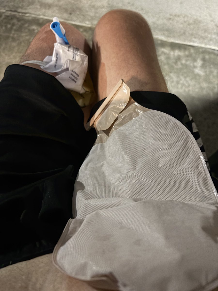 Spin519's tweet photo. @HHyperinflation I’m already missing 5 internal organs. Some due to third worlders Zero Safety. I can’t afford to lose anymore!! https://t.co/3W7P81kzKr