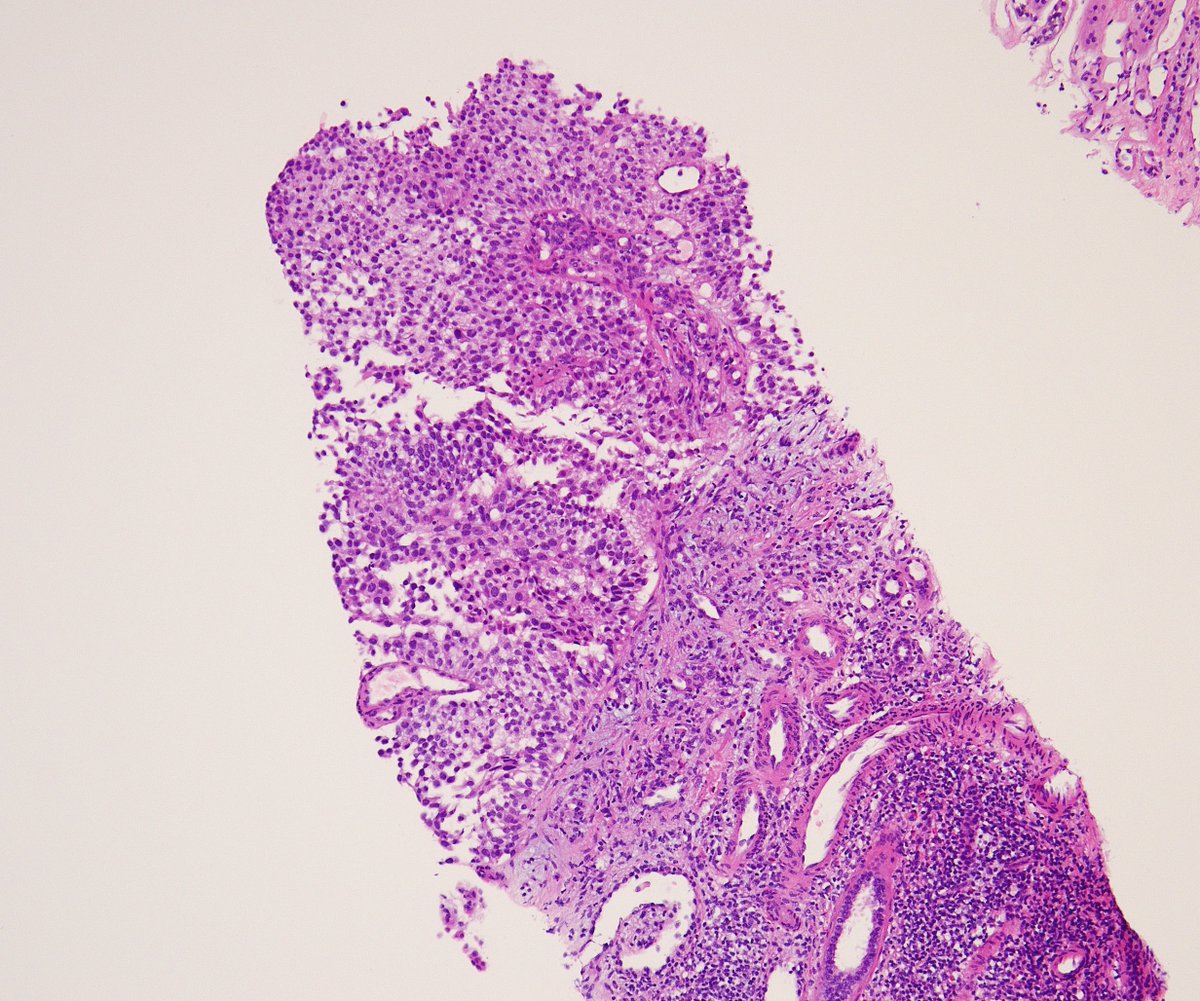 MirunaPopescu13's tweet photo. Renal biopsy in a middle-aged woman with a known history of NSCLC. Clinical query: primary renal tumor vs. metastasis?
PAX8 shows weak nuclear expression 🧐
So, renal cell carcinoma or is there another diagnosis here? 🔬
#GUPath #PathTwitter https://t.co/P9tEP2taA6