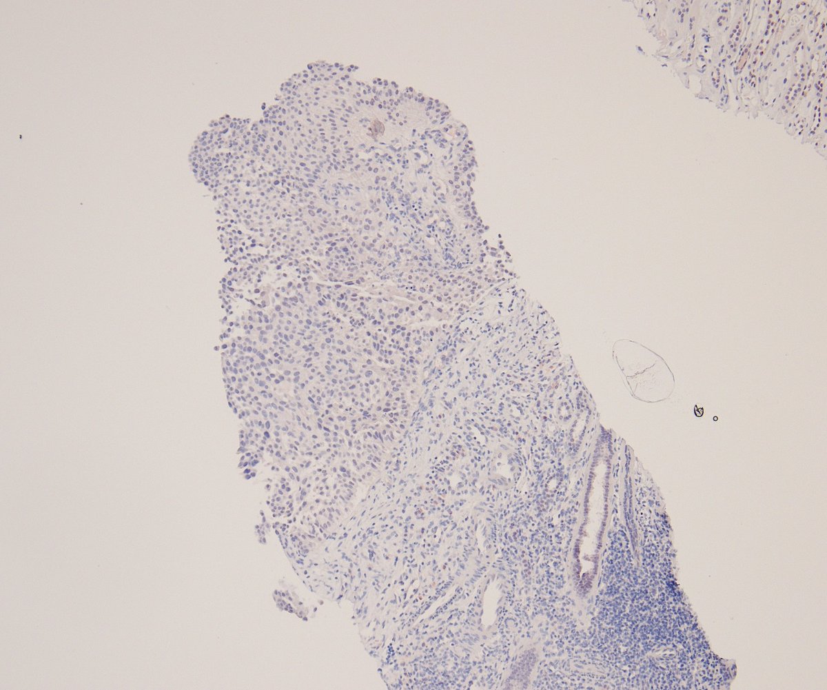 MirunaPopescu13's tweet photo. Renal biopsy in a middle-aged woman with a known history of NSCLC. Clinical query: primary renal tumor vs. metastasis?
PAX8 shows weak nuclear expression 🧐
So, renal cell carcinoma or is there another diagnosis here? 🔬
#GUPath #PathTwitter https://t.co/P9tEP2taA6