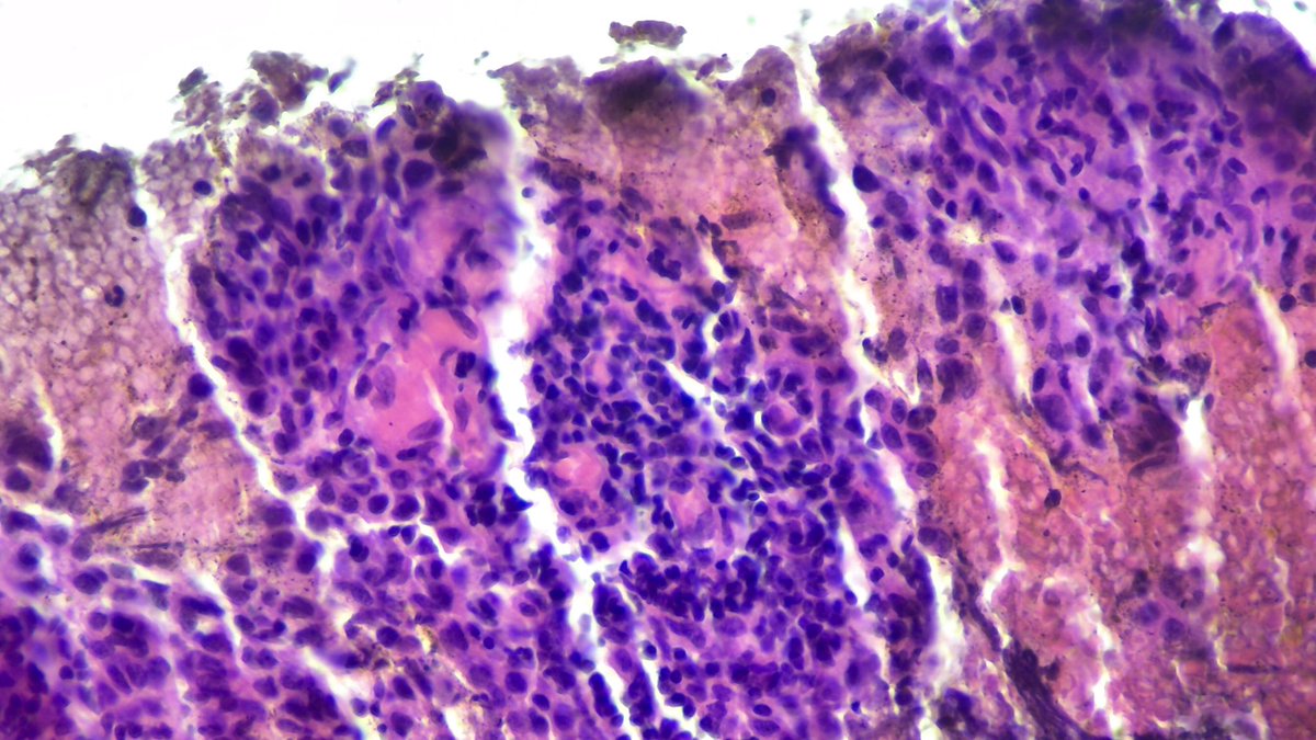 Maythamkraidi's tweet photo. An 80-year-old female with an 8-year history of a crusted plaque on the scalp.
#PathTwitter #Skin #Pathologist #DermTwitter #DermPath https://t.co/ijAnXPFLkL