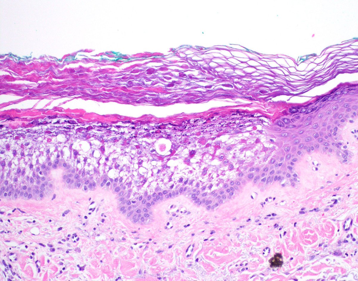 JMGardnerMD's tweet photo. Focal finding in BCC excision. What is it?
Answer✅ https://t.co/6iEWrQiQ32
More cases🔬https://t.co/WaPB2UBh5j & https://t.co/kQla9FtPyc
#pathology #pathologists #pathTwitter #dermpath #dermatology #dermtwitter https://t.co/xZZHG1HJ7f