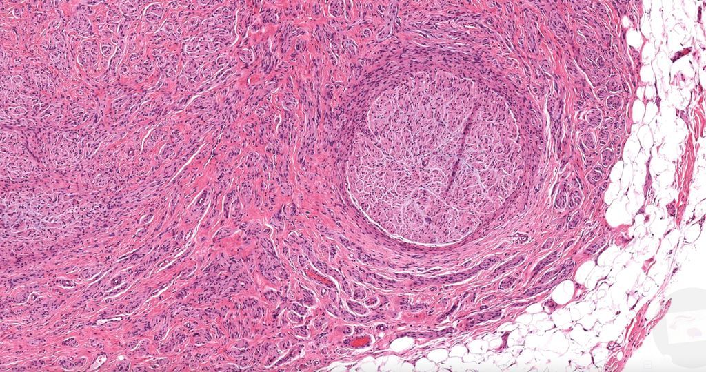 JMGardnerMD's tweet photo. Painful nodule. Your diagnosis?
Digital slide: https://t.co/gs4VAPb4D2. Answer ✅ https://t.co/B8ZpLK3Tlq
#BSTpath #pathology #pathologists #pathTwitter #dermpath #dermatology #dermatologia #dermtwitter https://t.co/traSxKchm4