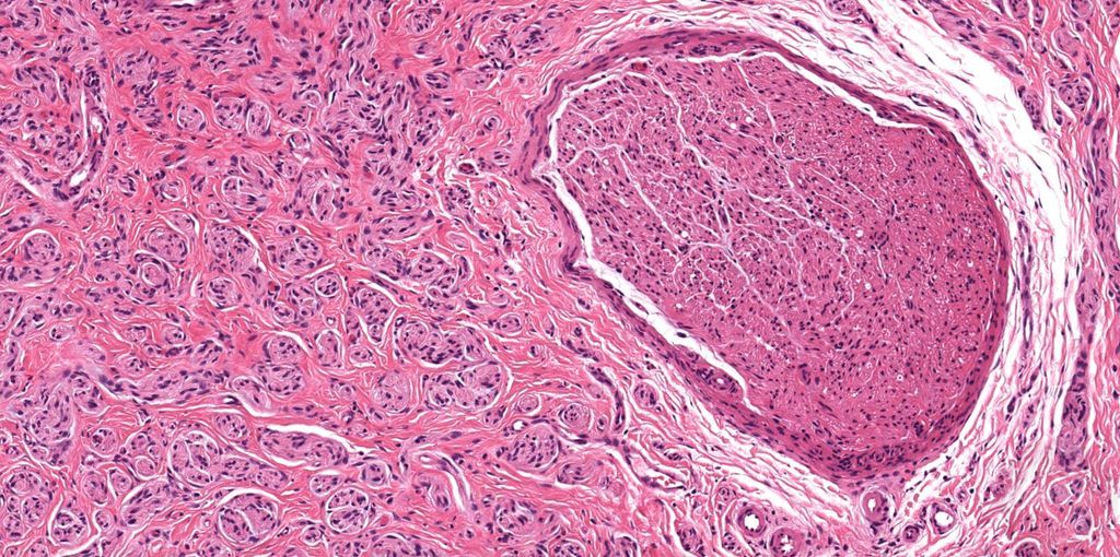 JMGardnerMD's tweet photo. Painful nodule. Your diagnosis?
Digital slide: https://t.co/gs4VAPb4D2. Answer ✅ https://t.co/B8ZpLK3Tlq
#BSTpath #pathology #pathologists #pathTwitter #dermpath #dermatology #dermatologia #dermtwitter https://t.co/traSxKchm4