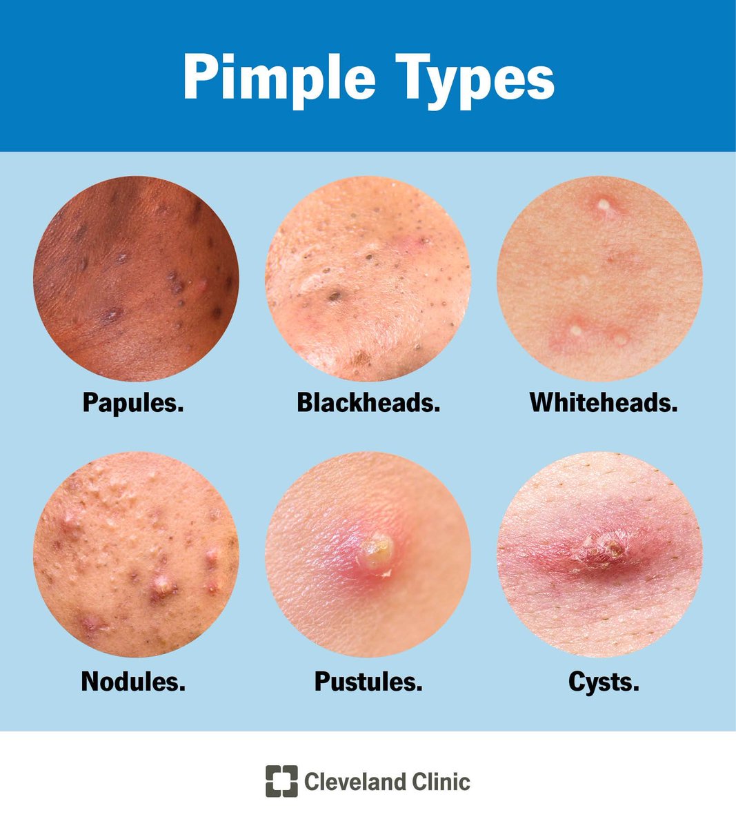DestinyRebound's tweet photo. 🚨 ACNE WON’T GO AWAY? 😩 Clearer skin starts with understanding the real causes! ✨ Discover effective acne treatments and skincare tips your skin will thank you for! 💙👇

🔗 https://t.co/MgvTWTqIV5

#AcneFree #ClearSkin #SkincareTips #HealthySkin #AcneTreatment https://t.co/IVDWPcQPzP