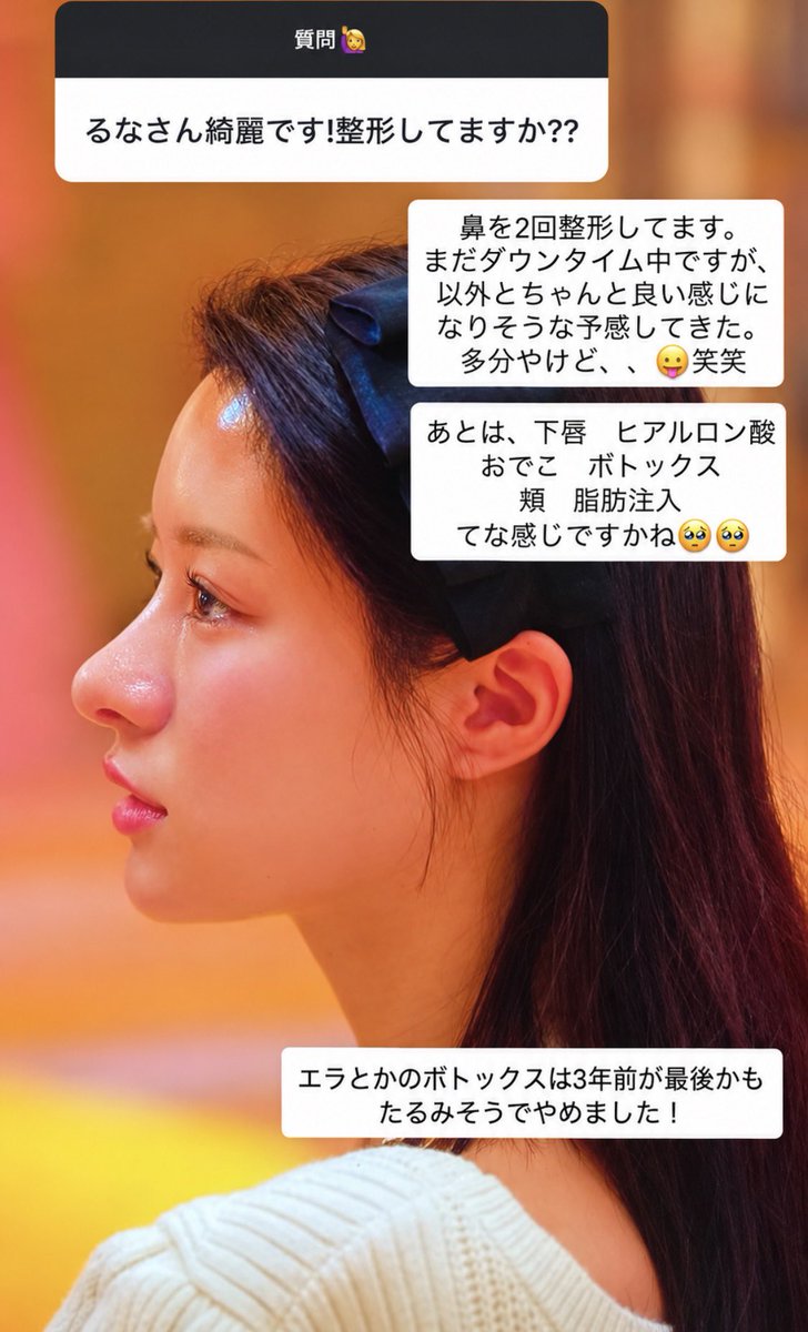 rin3ten's tweet photo. ラヴ上等のみみ、ほんまに理想的よな。

元は口ゴボの低鼻の保育士から、鼻整形・足の脂肪吸引・額や頬脂肪注入・肌管理で単価を上げてNo. 1キャバ嬢にまで上り詰め、30手前で未練なくスパッとキャバ嬢辞めてルネと👫🫶

課金レシピまじに役立つこれ👇 https://t.co/iwN0TAUfDr