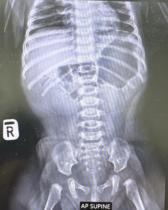 DGHisham's tweet photo. Recently, we managed a child who presented with red currant jelly stools. The child had been treated for dysentery at other medical facilities without any imaging. 

The child was later referred to UCSI Hospital for further management. Abdominal radiography and ultrasound confirmed the diagnosis of intussusception. Three attempts at ultrasound-guided saline reduction were unsuccessful because the intussusceptum was very tight and congested. The child therefore underwent urgent surgery, during which the intussusception was successfully reduced. The bowel appeared congested but viable after being wrapped in warmed packs for 10 minutes. Bowel resection and stoma formation were avoided.

Lessons learned

1. Red currant jelly stools are a late sign of intussusception and require urgent medical attention and prompt treatment.
2. Per rectal bleeding in a child should never be dismissed without further imaging or investigation. Delay in presentation can lead to gangrenous, non-viable bowel.
3. Good referral pathways are essential so that a child can be promptly referred and transferred to a centre with a paediatric surgeon.
4. Once the diagnosis is confirmed, prompt action is required. This relies on excellent teamwork among the radiologist, nursing team, OT team, and anaesthetist to avoid morbidity.

We thank Professor Dr. Yik Yee Ian, Resident Paediatric Surgeon at UCSI Hospital, and his entire team for a job well done in saving this child’s life.