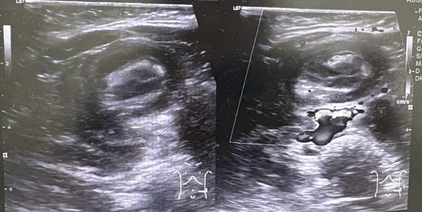 DGHisham's tweet photo. Recently, we managed a child who presented with red currant jelly stools. The child had been treated for dysentery at other medical facilities without any imaging. 

The child was later referred to UCSI Hospital for further management. Abdominal radiography and ultrasound confirmed the diagnosis of intussusception. Three attempts at ultrasound-guided saline reduction were unsuccessful because the intussusceptum was very tight and congested. The child therefore underwent urgent surgery, during which the intussusception was successfully reduced. The bowel appeared congested but viable after being wrapped in warmed packs for 10 minutes. Bowel resection and stoma formation were avoided.

Lessons learned

1. Red currant jelly stools are a late sign of intussusception and require urgent medical attention and prompt treatment.
2. Per rectal bleeding in a child should never be dismissed without further imaging or investigation. Delay in presentation can lead to gangrenous, non-viable bowel.
3. Good referral pathways are essential so that a child can be promptly referred and transferred to a centre with a paediatric surgeon.
4. Once the diagnosis is confirmed, prompt action is required. This relies on excellent teamwork among the radiologist, nursing team, OT team, and anaesthetist to avoid morbidity.

We thank Professor Dr. Yik Yee Ian, Resident Paediatric Surgeon at UCSI Hospital, and his entire team for a job well done in saving this child’s life.