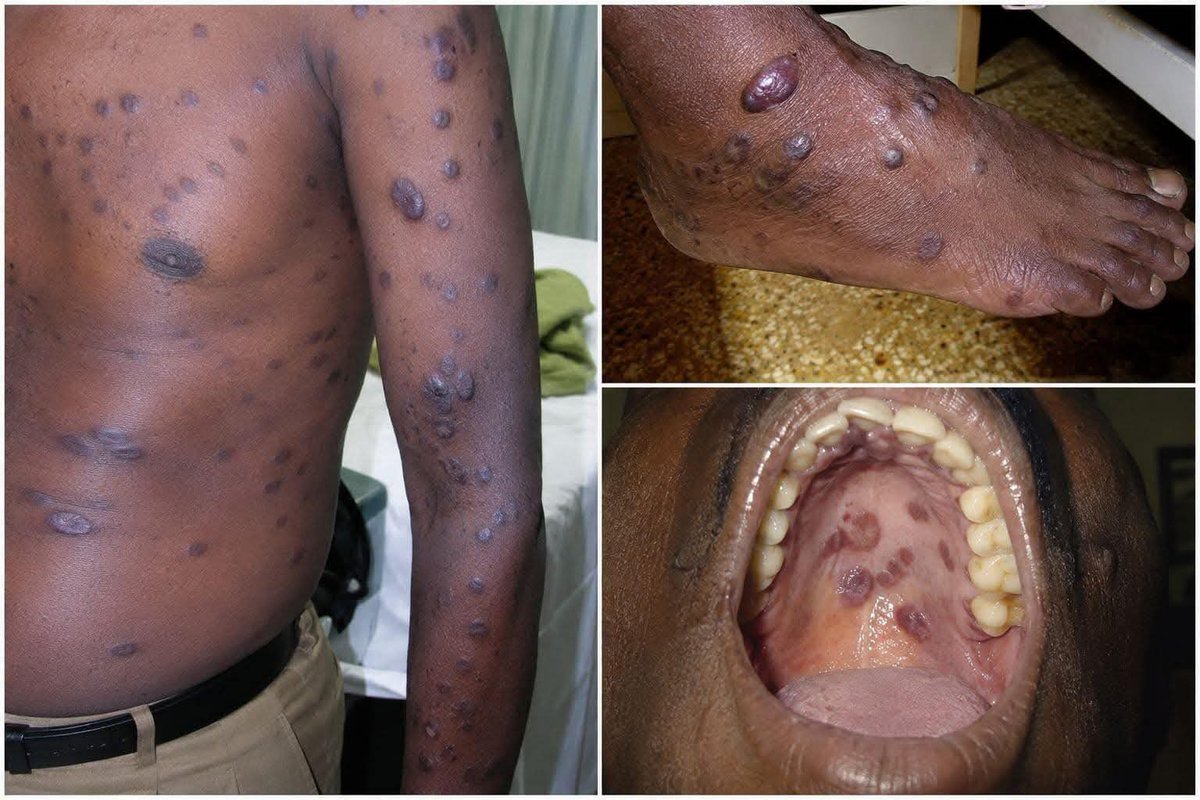 Stanley45438379's tweet photo. This is how HIV stage  3 looks . https://t.co/AJZnsDMn5z