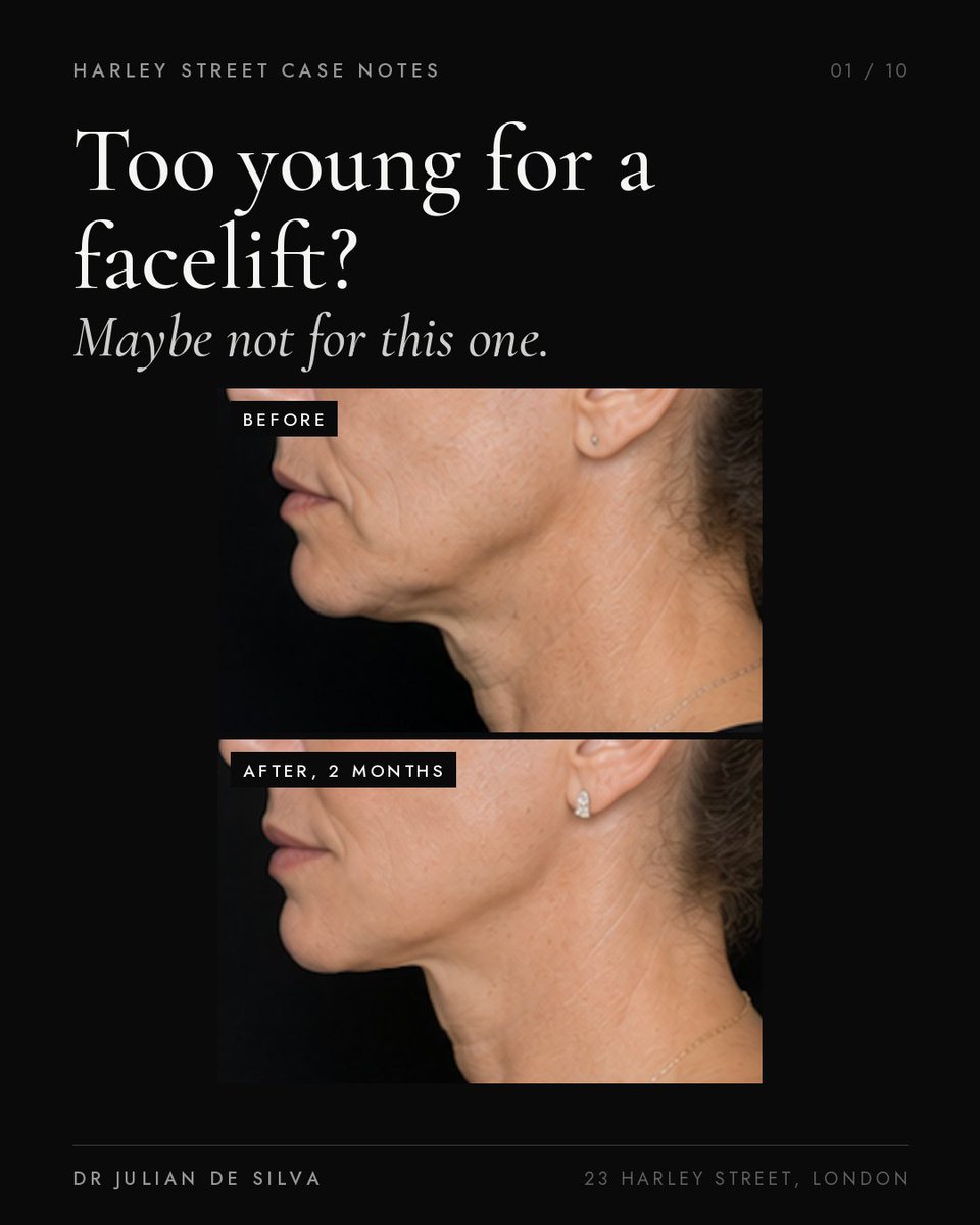 drjuliandesilva's tweet photo. Too young for a facelift at 45? Not for this one. Small incisions hidden in the hair, a little of her own fat, two months on. Individual results vary and all surgery carries risk. #facelift #endoscopicfacelift https://t.co/dggTiNLQB9