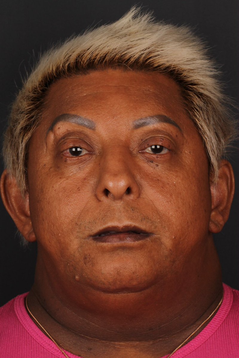 updatecharts's tweet photo. ANTES e DEPOIS de harmonização facial de Patixa Teló. https://t.co/4DklxjNme3