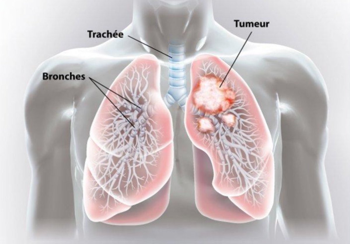 Myriamemmanuell's tweet photo. 📌 Le cancer du poumon

Le cancer du poumon est une maladie qui se développe lorsque des cellules anormales se multiplient de façon incontrôlée dans les poumons. Il peut toucher aussi bien les hommes que les femmes, les fumeurs comme les non-fumeurs.

Les causes du cancer du poumon

Le tabagisme est la principale cause de cette maladie. Cependant, d’autres facteurs peuvent également favoriser son apparition, notamment le tabagisme passif, la pollution de l’air, l’exposition à certaines substances toxiques comme l’amiante et le radon, ainsi que certains facteurs génétiques.

Les symptômes

Le cancer du poumon peut rester silencieux pendant longtemps. Lorsqu’il se manifeste, les symptômes les plus fréquents sont :

Une toux persistante ou qui change avec le temps.
Des douleurs dans la poitrine.
Un essoufflement inhabituel.
Des crachats contenant du sang.
Une fatigue persistante.
Une perte de poids inexpliquée.
Une perte d’appétit.
Des infections pulmonaires répétées.
Une voix enrouée qui ne disparaît pas.

Ces signes ne signifient pas forcément qu’il s’agit d’un cancer, mais ils doivent pousser à consulter un professionnel de santé, surtout lorsqu’ils persistent.

Les différents types de cancer du poumon

On distingue principalement deux grandes catégories : le cancer du poumon à petites cellules, qui évolue généralement rapidement, et le cancer du poumon non à petites cellules, qui représente la majorité des cas.

Le diagnostic

Pour rechercher un cancer du poumon, le médecin peut demander une radiographie du thorax, un scanner ou une bronchoscopie. Une biopsie peut également être réalisée pour analyser les cellules et confirmer le diagnostic.

Les traitements

Le traitement dépend du type de cancer, de son stade et de l’état de santé du patient. Il peut comprendre la chirurgie, la chimiothérapie, la radiothérapie, l’immunothérapie ou les thérapies ciblées. Plusieurs de ces traitements peuvent être associés.

Peut-on guérir du cancer du poumon ?

Oui, une guérison est possible, surtout lorsque la maladie est détectée à un stade précoce. Lorsque le cancer est plus avancé, les traitements peuvent permettre de ralentir son évolution, de prolonger la vie et de soulager les symptômes.

Comment prévenir le cancer du poumon ?

Pour réduire les risques, il est conseillé de ne pas fumer, d’éviter la fumée du tabac et de limiter l’exposition aux substances cancérogènes. Il est également important de consulter rapidement en cas de symptômes persistants.

Le cancer du poumon reste une maladie sérieuse, mais une prise en charge précoce peut améliorer les chances de traitement. La prévention et la consultation médicale jouent donc un rôle essentiel.