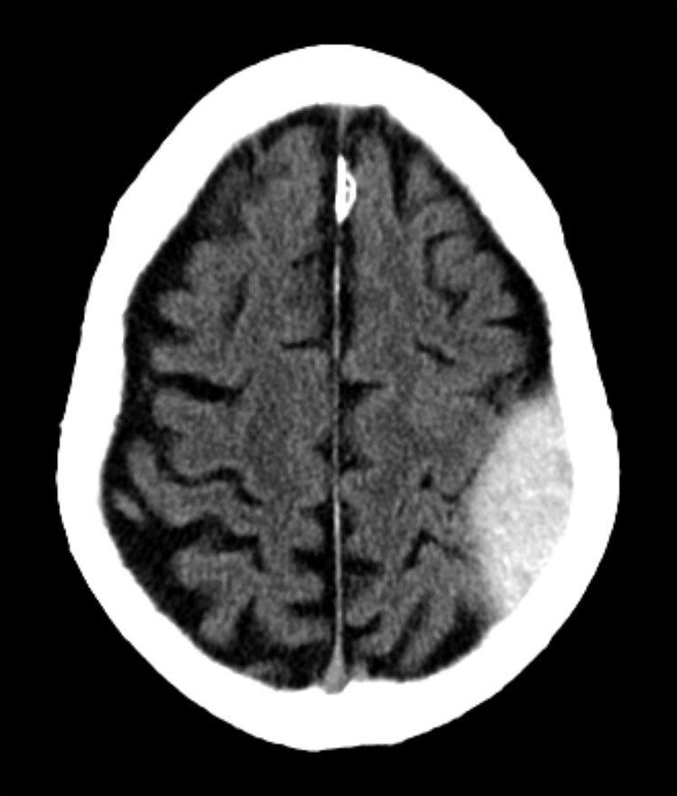 RadMasterclass's tweet photo. CT BRAIN QUIZ: Alcoholic found unconscious. What does the image show?
A: Subdural haematoma
B: Subarachnoid haemorrhage
C: Intraventricular haemorrhage
D: Extradural haematoma
E: Intracerebral haemorrhage
Start Quiz https://t.co/vFJ973Yknb https://t.co/p9lODIXGXE