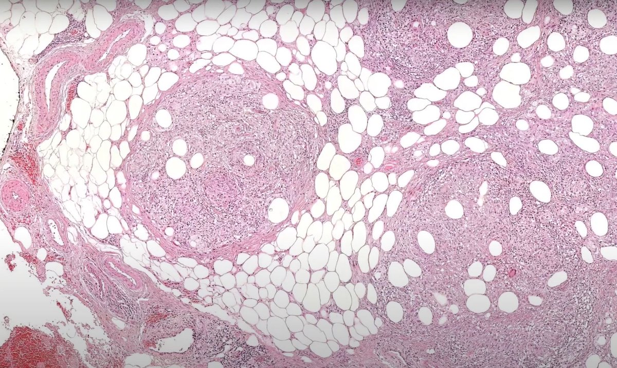 JMGardnerMD's tweet photo. Red nodules on bilateral legs of young adult with chronic cough & night sweats.
Cultures from this LEG lesion would be NEGATIVE. Diagnosis?
Answer ✅ https://t.co/vQepKN4AL0
#pathology #pathologists #pathTwitter #dermpath #dermatology #dermatologia #dermtwitter https://t.co/vjcEy7qMDd