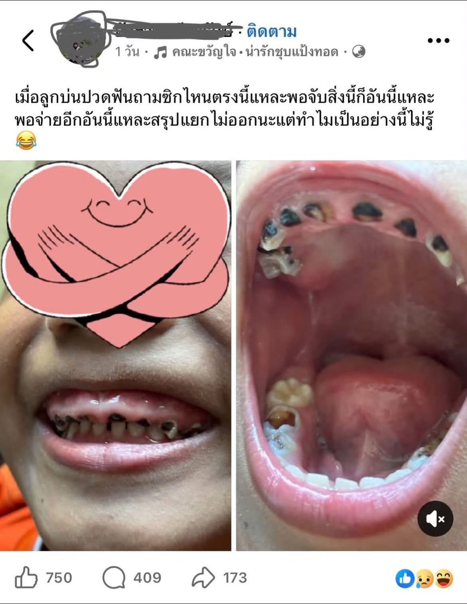 M0M0N64's tweet photo. ม๊าเล่าให้ฟังว่า ถ้าอยากรู้ว่า บ้านไหนดูแลเด็กดีหรือเปล่า ให้ดูที่ฟันของเด็ก ถ้าไม่ผุ = พ่อแม่ผู้ปกครอง เลี้ยงดีค่ะ 

กรณีนี้ สงสารน้องจัง🥹 https://t.co/FQxA399lPZ