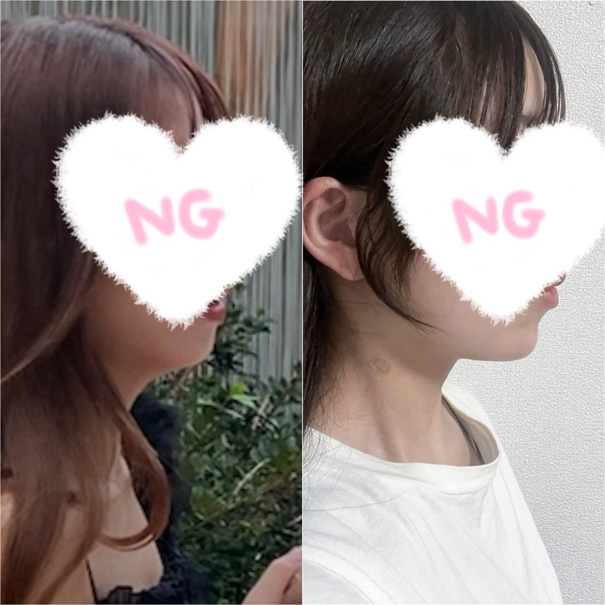 04__melo's tweet photo. ←befor
　　　　after→

顎下脂肪吸引から1ヶ月半経った🥺
やって良かったすぎる大満足〜🥺🥺

ビフォーちゃんと撮れば良かったな💧

#整形垢さんと繋がりたい
 #美容垢さんと繋がりたい 
#整形垢 https://t.co/nevjYsULFw