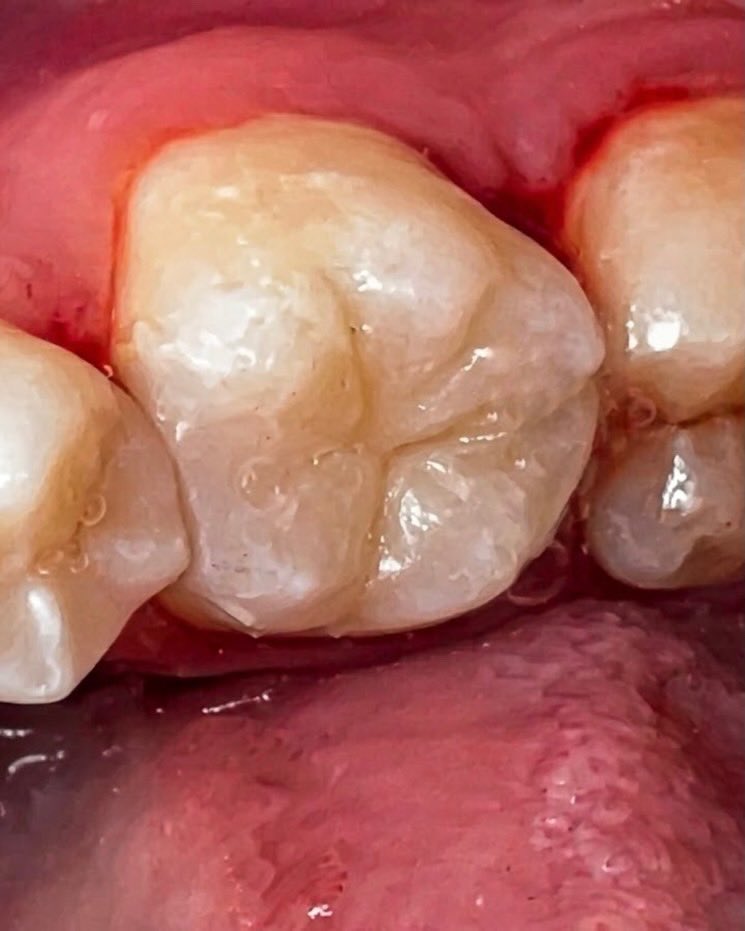 slo_s24's tweet photo. Class II MOD composite restoration .
#Dentistry #operative https://t.co/icYsrDRZKe