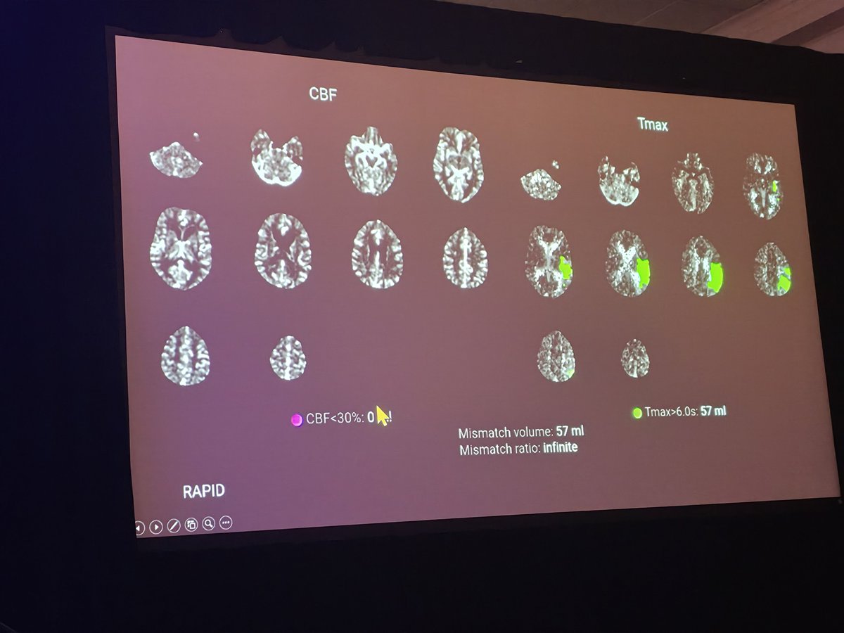 theASFNR's tweet photo. @tim0shepherd Next up @dhairyalakhani and @pranj_rad discussing CTP in acute stroke at #ASFNR26  @thecortexclub @MohitTCCNeuro @Aakanksha_md https://t.co/X5sX7PkZSe