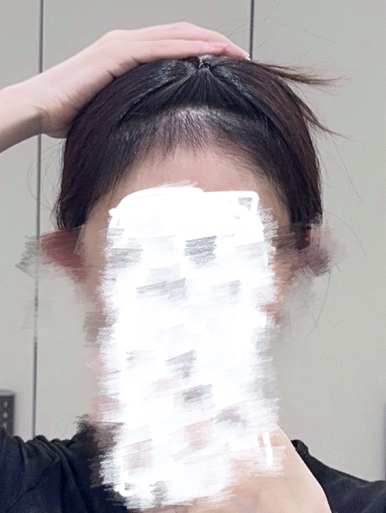 omonaga_life's tweet photo. ちょっと待って、クリニックで洗顔前に前髪あげたら毛生えすぎてて焦ったwwwww

これうぶ毛じゃなくてそのまま前髪になるやつじゃん！！！！！

おでこ確実に3cmは縮んだし小顔効果やばい顔面の面積バグった
ミノキシジルすごい

(身バレするくらいｷﾓｲスマホカバー使ってるので特大モザイクごめん) https://t.co/gIeKtsPVsX