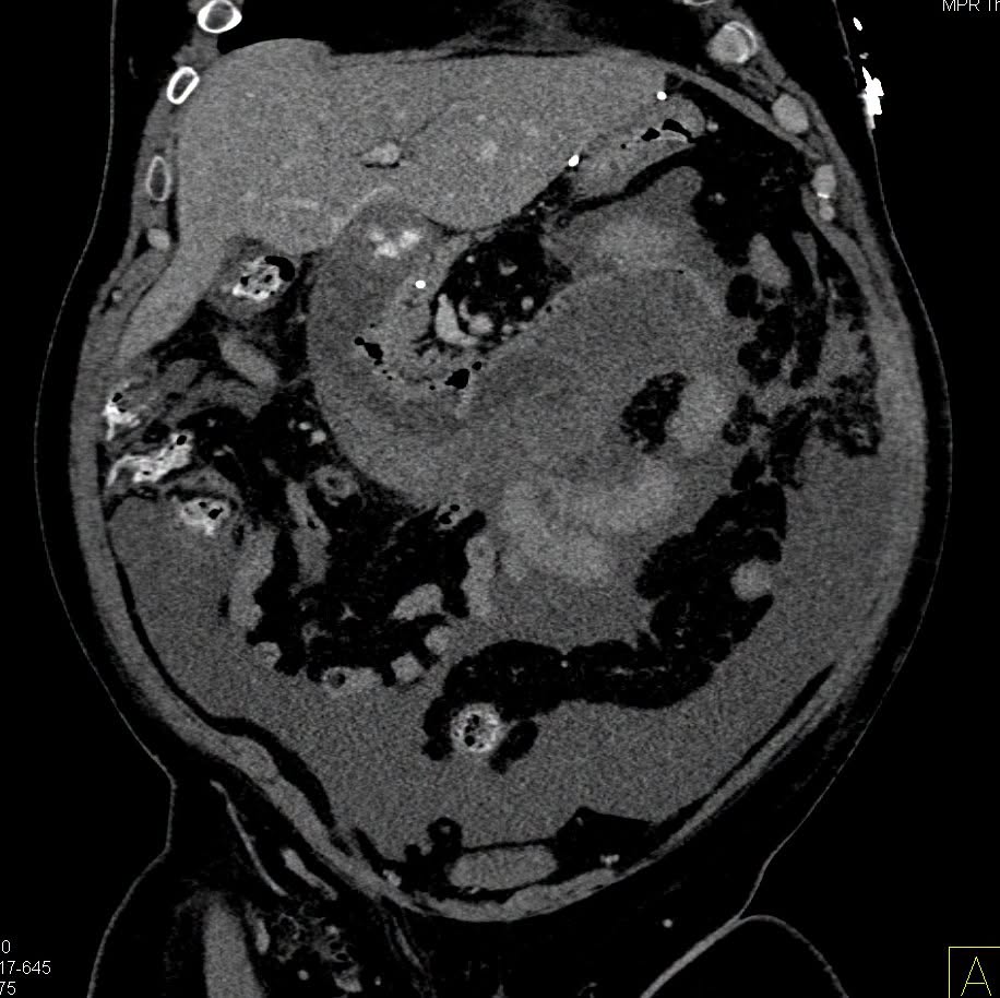 ctisus's tweet photo. Duodenal Hematoma https://t.co/2RVAwVaHUL