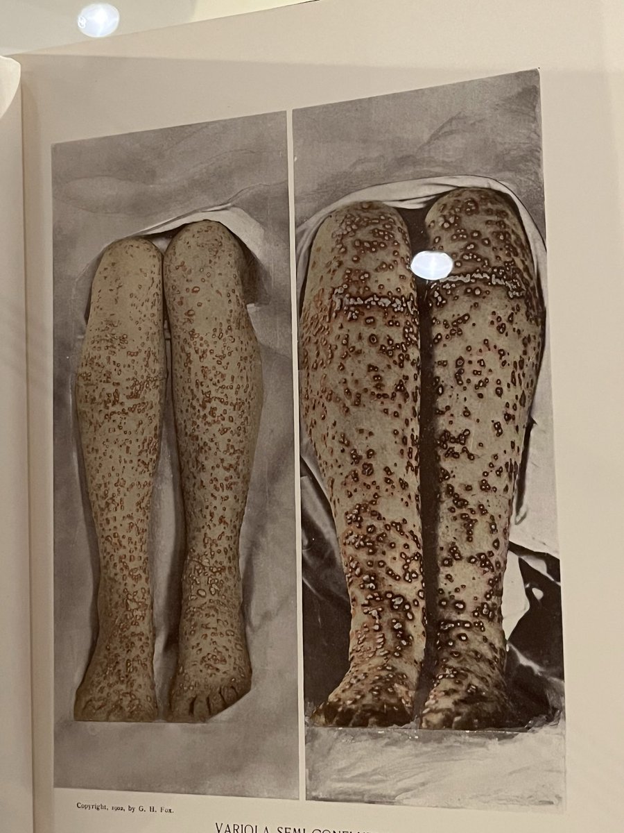 Barb_Drummond's tweet photo. Before #vaccination the horrors of #smallpox. Women scarred by it never married https://t.co/k51ZGYJWPJ