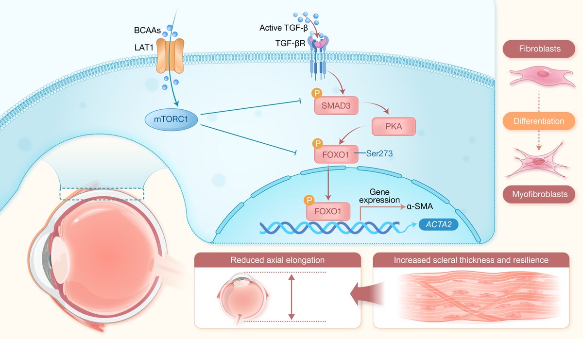hLife_2023's tweet photo. 👁️ Could amino acid metabolism hold clues to myopia progression?

A new study in hLife links branched-chain amino acid depletion to adolescent myopia progression through mTORC1-dependent scleral remodeling.

🔗 https://t.co/6o4sVkhqyY https://t.co/v0yyIXybvI